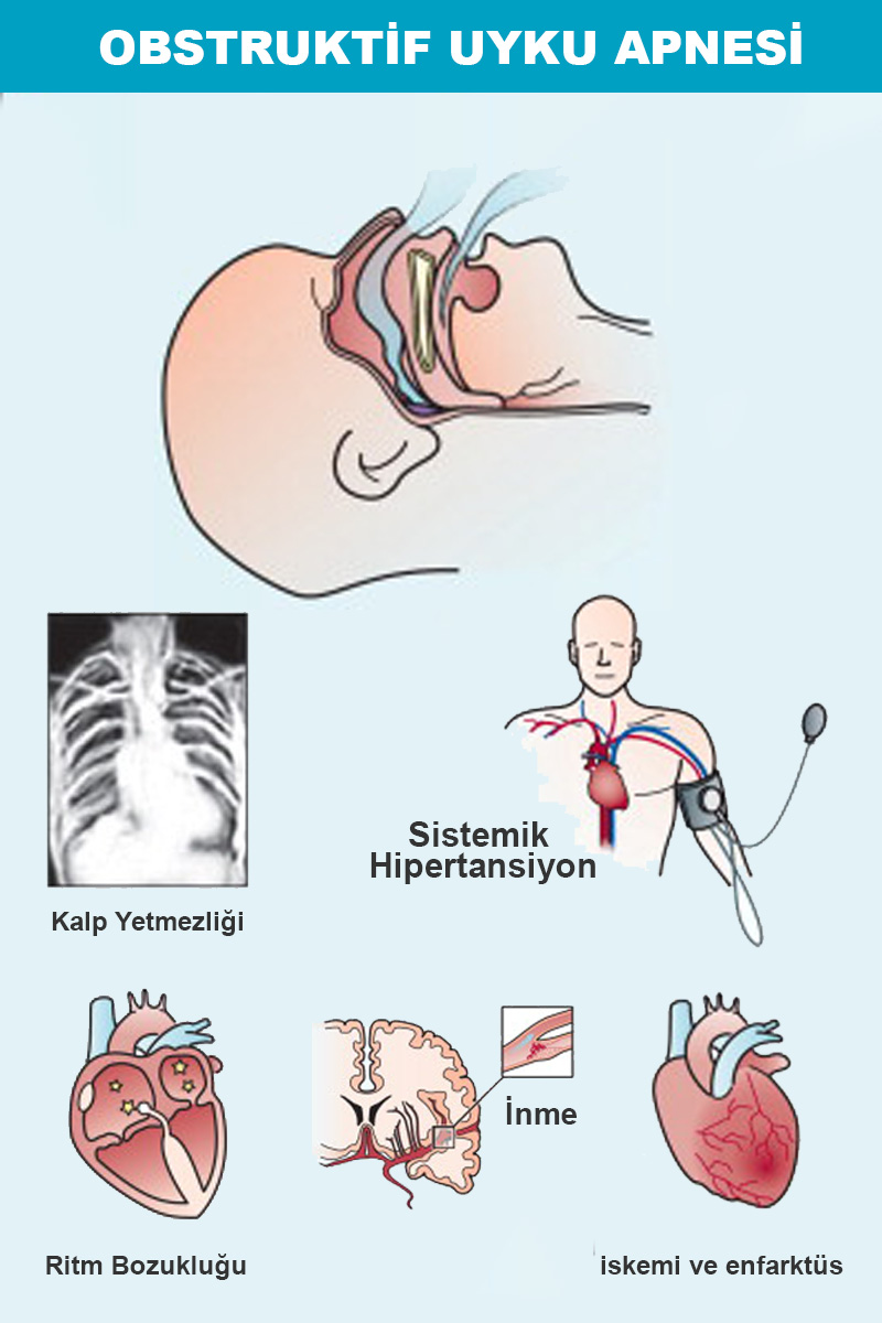 uyku_apnesi_cizim1.jpg